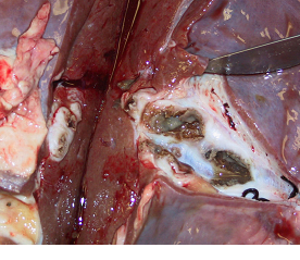 Marked fibrous reaction in fluke infested liver