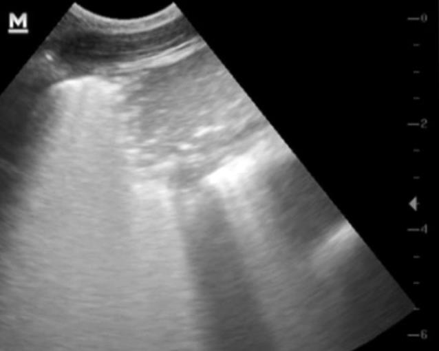 Hypoechoic OPA lesion