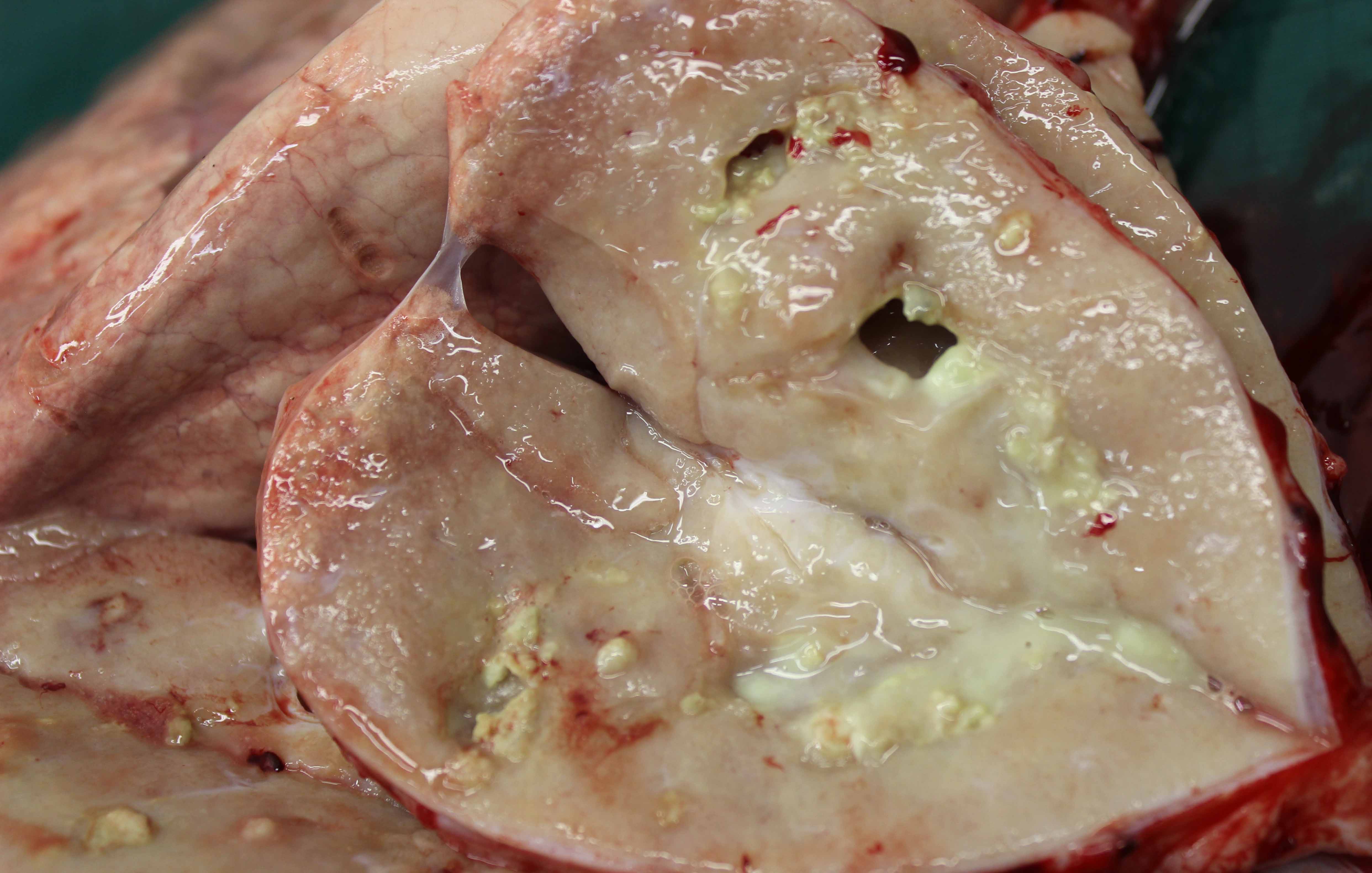 Extensive fibrosis surrounding lung abscesses