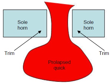 Sole ulceration