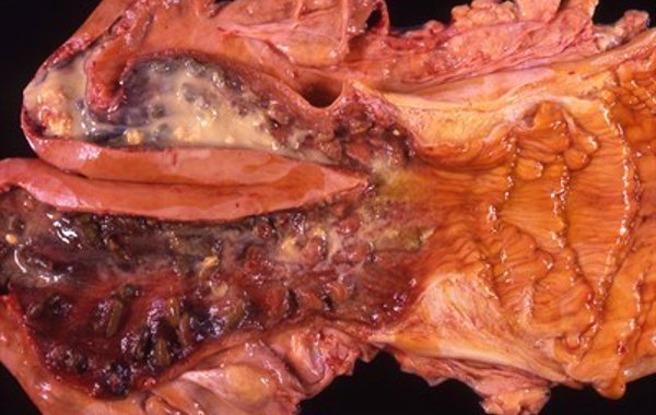 Part 7 - Uterine Infection